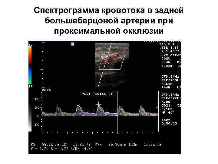 Спектрограмма кровотока в задней большеберцовой артерии проксимальной окклюзии 