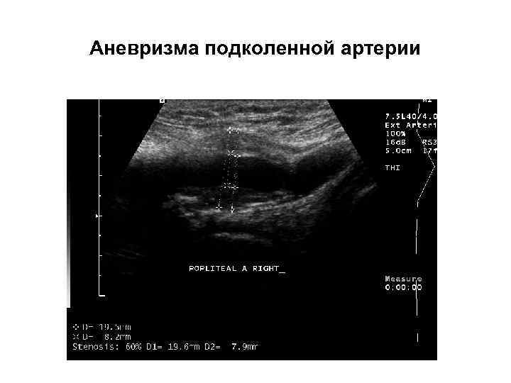 Аневризма подколенной артерии 