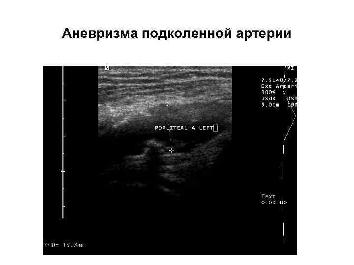 Аневризма подколенной артерии 