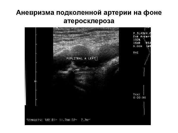 Аневризма подколенной артерии на фоне атеросклероза 