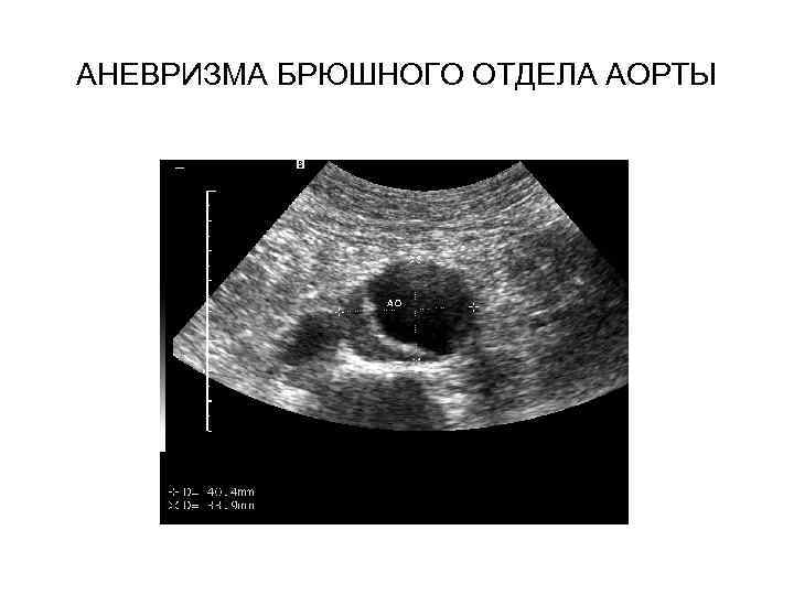 АНЕВРИЗМА БРЮШНОГО ОТДЕЛА АОРТЫ 