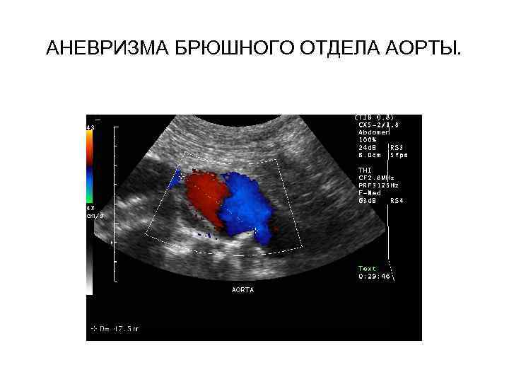 АНЕВРИЗМА БРЮШНОГО ОТДЕЛА АОРТЫ. 