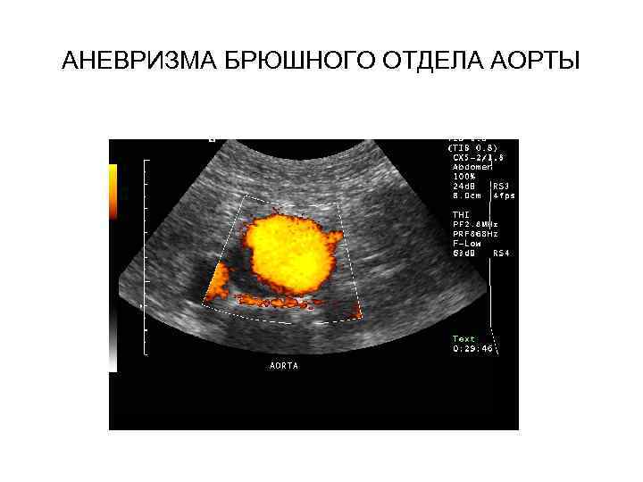 АНЕВРИЗМА БРЮШНОГО ОТДЕЛА АОРТЫ 