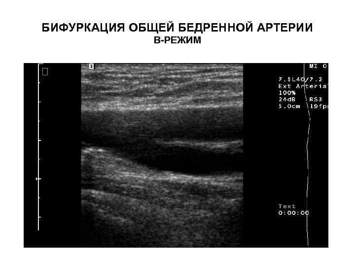 БИФУРКАЦИЯ ОБЩЕЙ БЕДРЕННОЙ АРТЕРИИ В-РЕЖИМ 