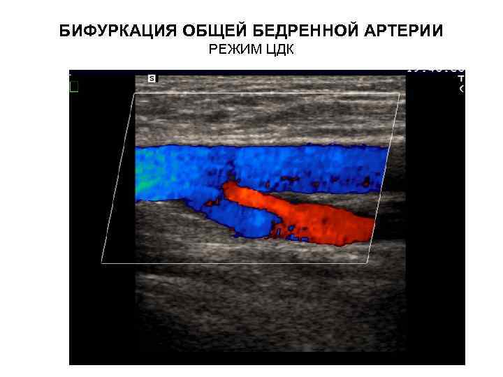 БИФУРКАЦИЯ ОБЩЕЙ БЕДРЕННОЙ АРТЕРИИ РЕЖИМ ЦДК 