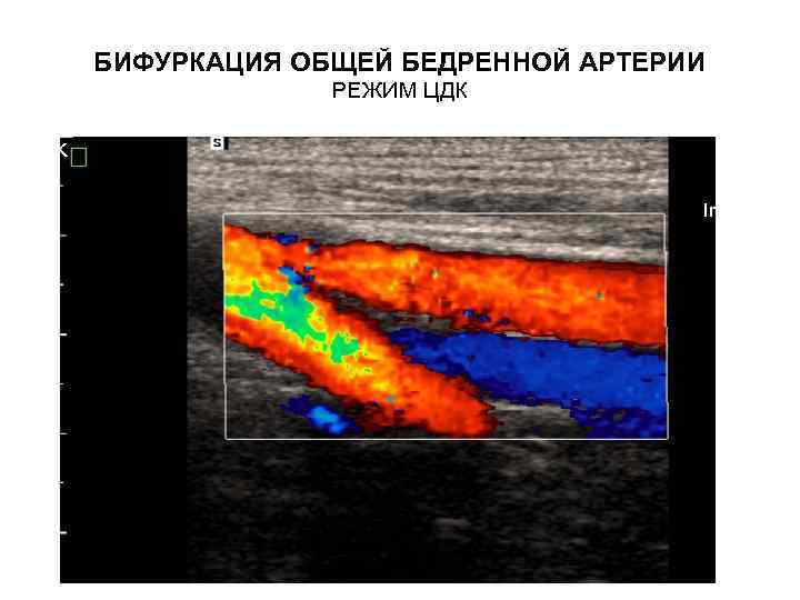 БИФУРКАЦИЯ ОБЩЕЙ БЕДРЕННОЙ АРТЕРИИ РЕЖИМ ЦДК 