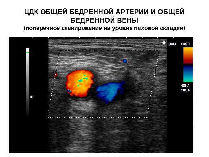 ЦДК ОБЩЕЙ БЕДРЕННОЙ АРТЕРИИ И ОБЩЕЙ БЕДРЕННОЙ ВЕНЫ (поперечное сканирование на уровне паховой складки)