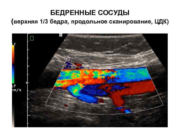 БЕДРЕННЫЕ СОСУДЫ (верхняя 1/3 бедра, продольное сканирование, ЦДК) 