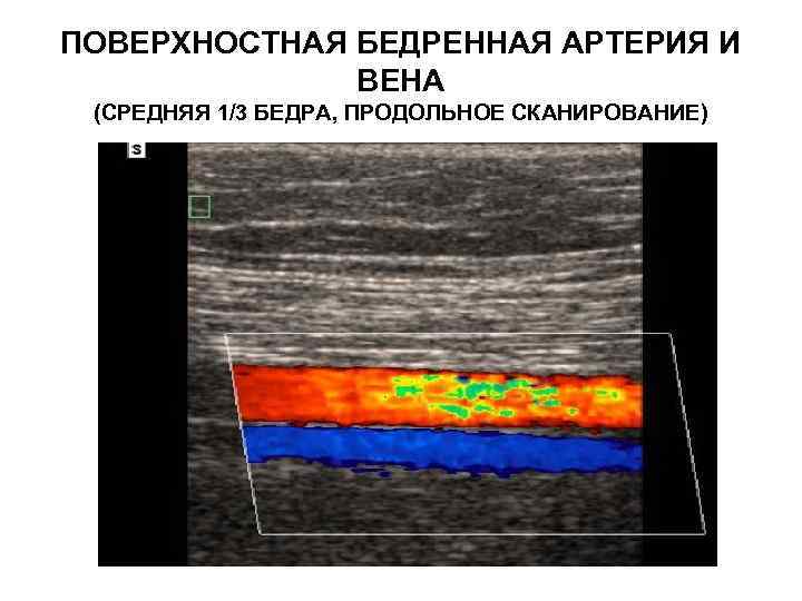 ПОВЕРХНОСТНАЯ БЕДРЕННАЯ АРТЕРИЯ И ВЕНА (СРЕДНЯЯ 1/3 БЕДРА, ПРОДОЛЬНОЕ СКАНИРОВАНИЕ) 