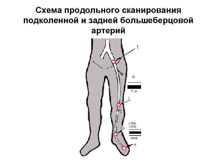 Схема продольного сканирования подколенной и задней большеберцовой артерий 