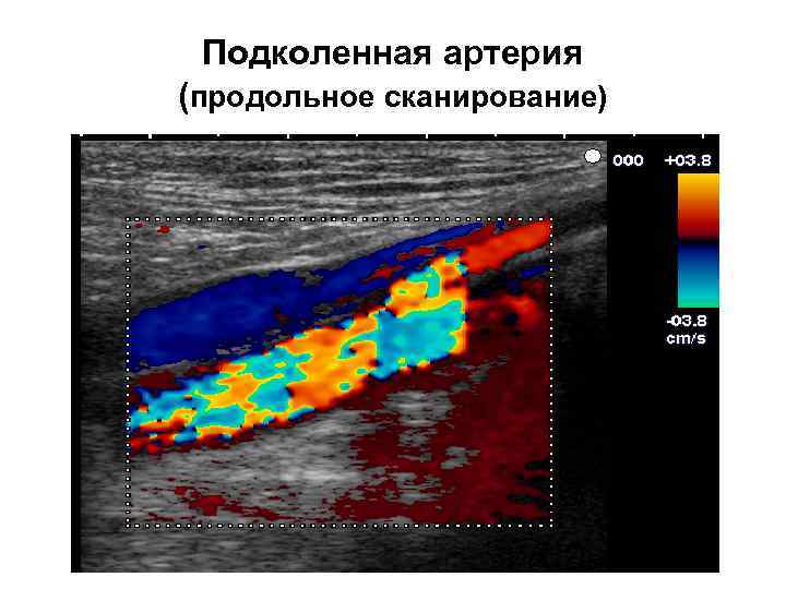 Подколенная артерия (продольное сканирование) 