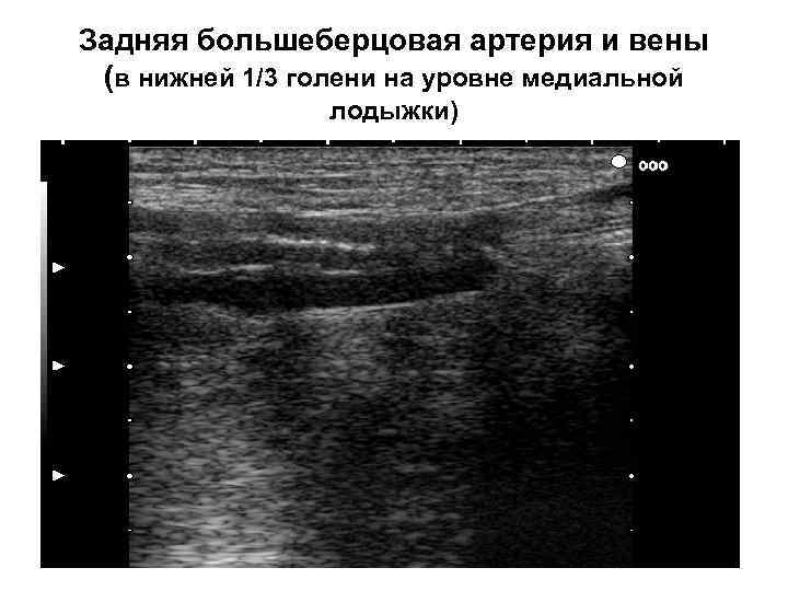 Задняя большеберцовая артерия и вены (в нижней 1/3 голени на уровне медиальной лодыжки) 