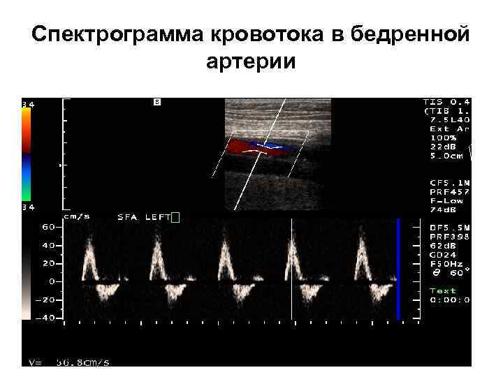 Спектрограмма кровотока в бедренной артерии 