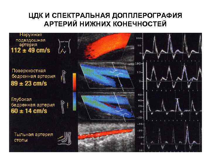 ЦДК И СПЕКТРАЛЬНАЯ ДОППЛЕРОГРАФИЯ АРТЕРИЙ НИЖНИХ КОНЕЧНОСТЕЙ 