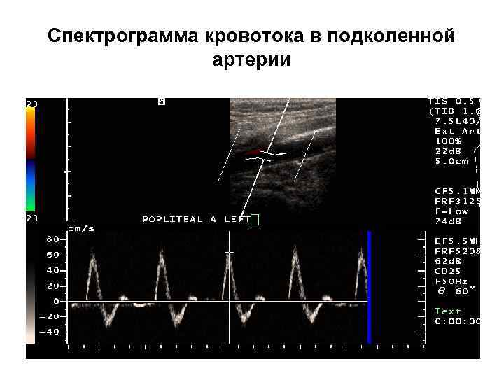 Спектрограмма кровотока в подколенной артерии 