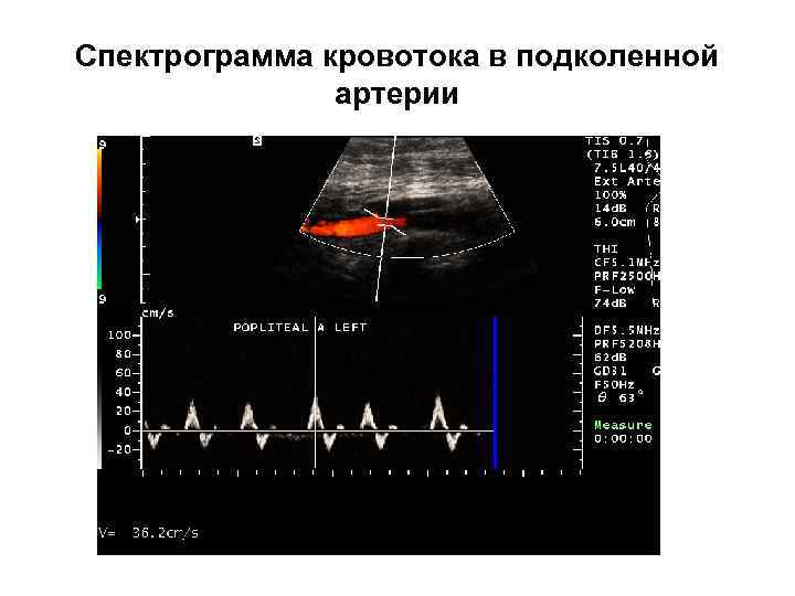 Спектрограмма кровотока в подколенной артерии 