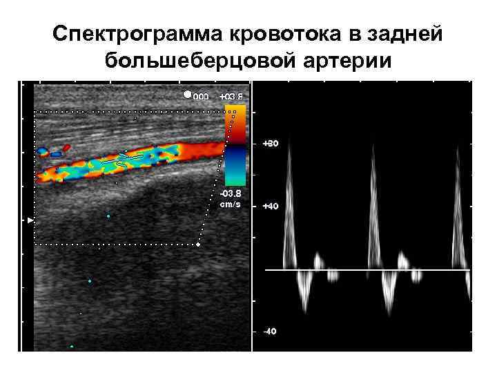 Спектрограмма кровотока в задней большеберцовой артерии 