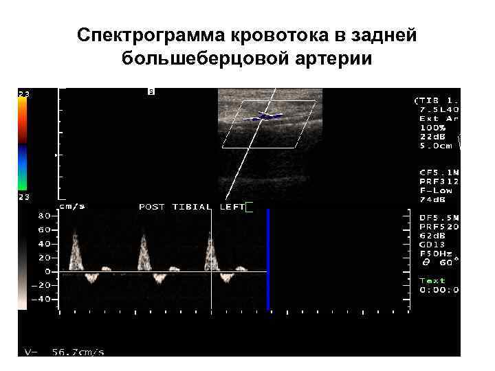 Спектрограмма кровотока в задней большеберцовой артерии 