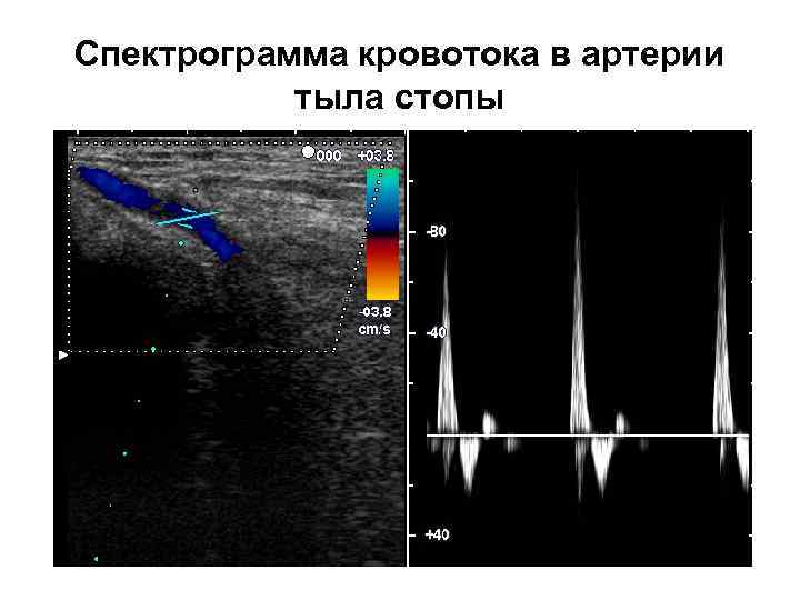 Спектрограмма кровотока в артерии тыла стопы 