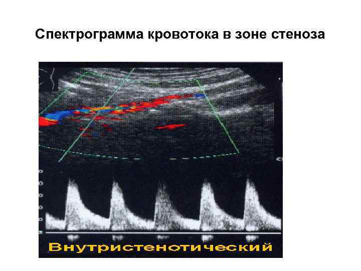 Спектрограмма кровотока в зоне стеноза 