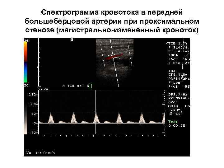 Спектрограмма кровотока в передней большеберцовой артерии проксимальном стенозе (магистрально-измененный кровоток) 