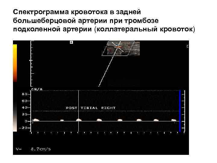 Спектрограмма кровотока в задней большеберцовой артерии при тромбозе подколенной артерии (коллатеральный кровоток) 