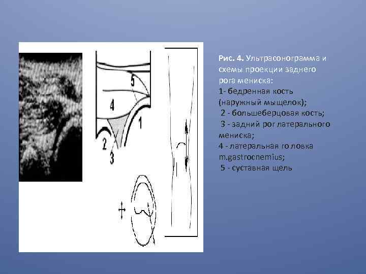 Рис. 4. Ультрасонограмма и схемы проекции заднего рога мениска: 1 - бедренная кость (наружный