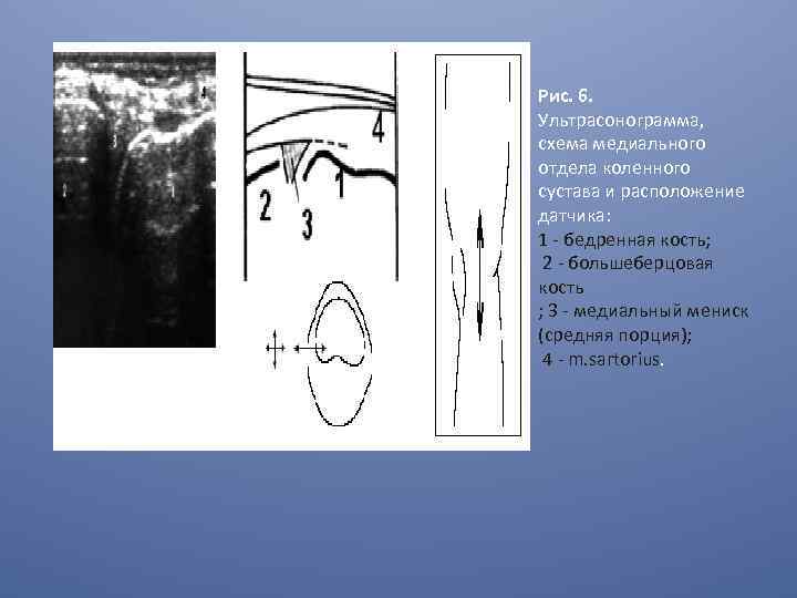 Рис. 6. Ультрасонограмма, схема медиального отдела коленного сустава и расположение датчика: 1 - бедренная