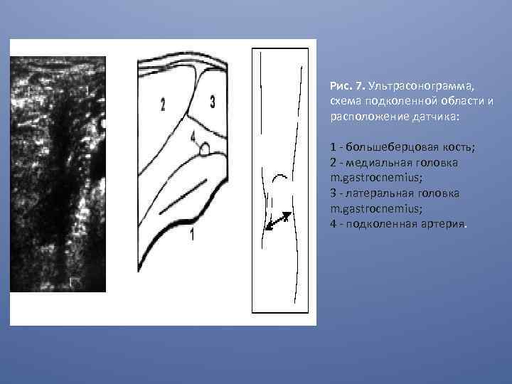 Рис. 7. Ультрасонограмма, схема подколенной области и расположение датчика: 1 - большеберцовая кость; 2
