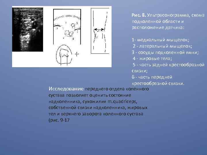 Рис. 8. Ультрасонограмма, схема подколенной области и расположение датчика: 1 - медиальный мыщелок; 2