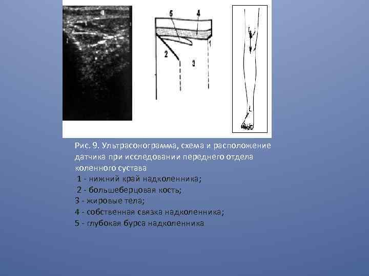Рис. 9. Ультрасонограмма, схема и расположение датчика при исследовании переднего отдела коленного сустава 1