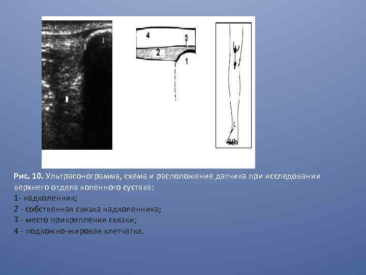 Рис. 10. Ультрасонограмма, схема и расположение датчика при исследовании верхнего отдела коленного сустава: 1