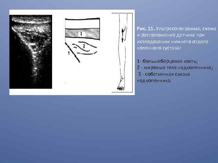 Узи коленного сустава нижний. Ультразвуковая анатомия коленного сустава. Ультразвуковая анатомия анатомия коленного сустава. УЗИ коленного сустава норма. УЗИ анатомия коленного сустава.