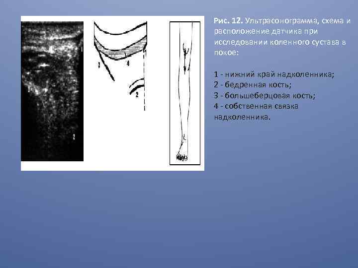 Рис. 12. Ультрасонограмма, схема и расположение датчика при исследовании коленного сустава в покое: 1