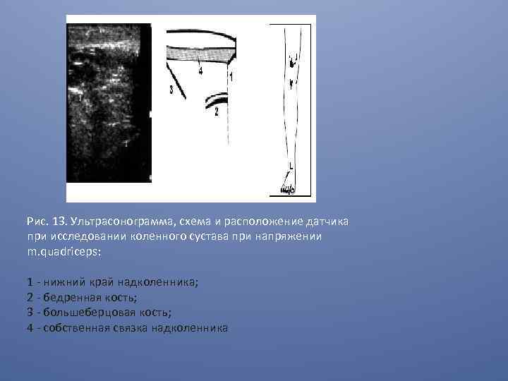 Рис. 13. Ультрасонограмма, схема и расположение датчика при исследовании коленного сустава при напряжении m.