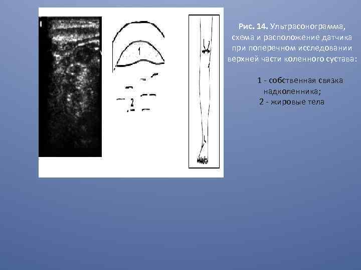 Рис. 14. Ультрасонограмма, схема и расположение датчика при поперечном исследовании верхней части коленного сустава: