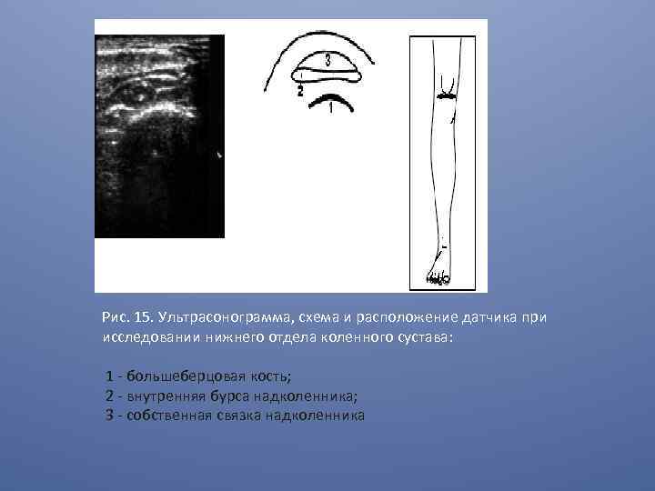 Рис. 15. Ультрасонограмма, схема и расположение датчика при исследовании нижнего отдела коленного сустава: 1