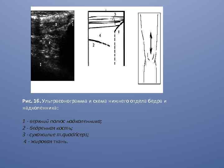 Рис. 16. Ультрасонограмма и схема нижнего отдела бедра и надколенника: 1 - верхний полюс