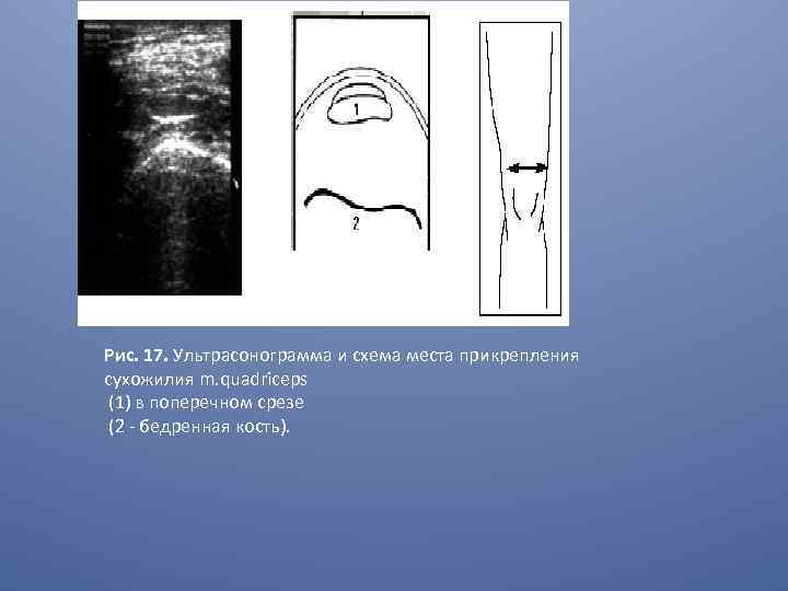 Рис. 17. Ультрасонограмма и схема места прикрепления сухожилия m. quadriceps (1) в поперечном срезе