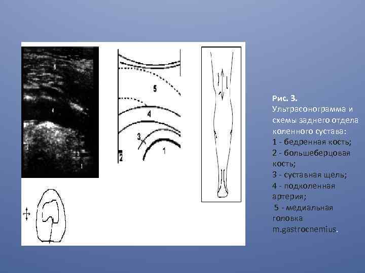 Рис. 3. Ультрасонограмма и схемы заднего отдела коленного сустава: 1 - бедренная кость; 2