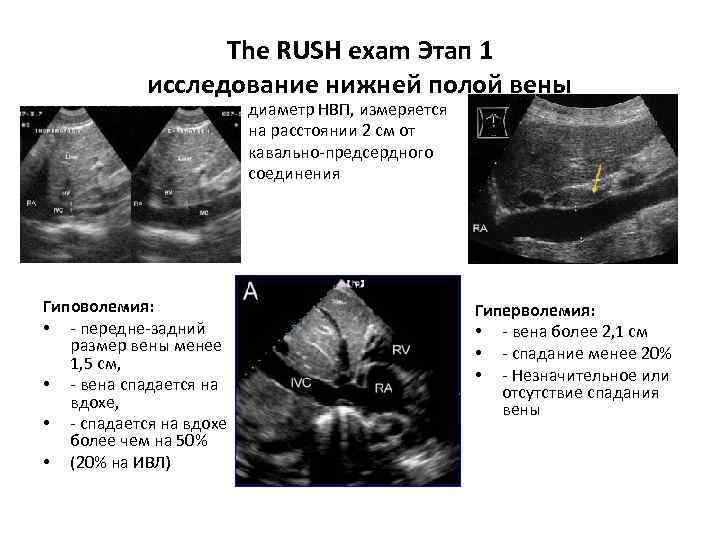 The RUSH exam Этап 1 исследование нижней полой вены диаметр НВП, измеряется на расстоянии