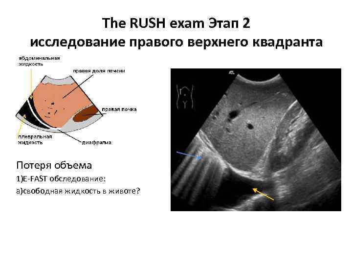 The RUSH exam Этап 2 исследование правого верхнего квадранта Потеря объема 1)E-FAST обследование: a)свободная