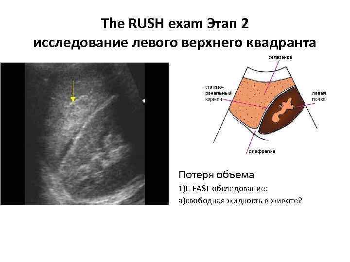 The RUSH exam Этап 2 исследование левого верхнего квадранта Потеря объема 1)E-FAST обследование: a)свободная