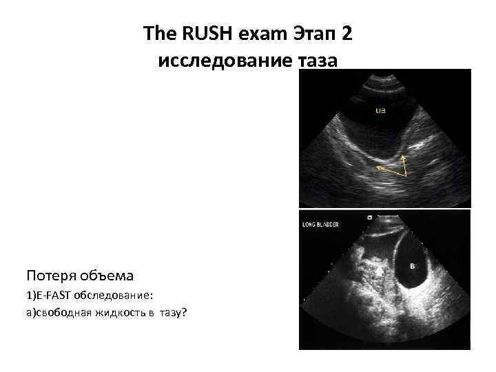 The RUSH exam Этап 2 исследование таза Потеря объема 1)E-FAST обследование: a)свободная жидкость в