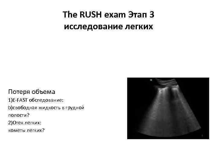 The RUSH exam Этап 3 исследование легких Потеря объема 1)E-FAST обследование: b)свободная жидкость в