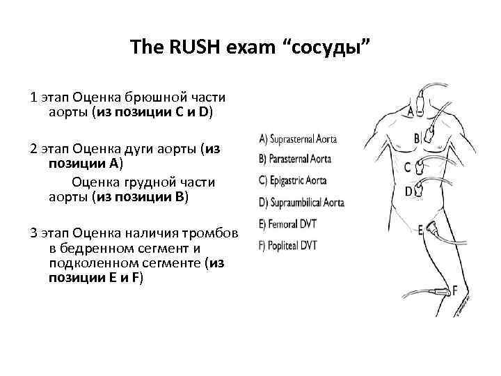 The RUSH exam “сосуды” 1 этап Оценка брюшной части аорты (из позиции С и