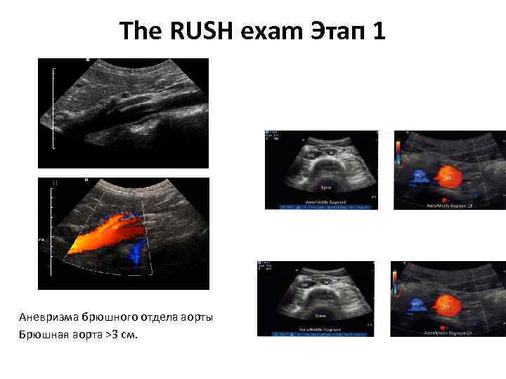 The RUSH exam Этап 1 Аневризма брюшного отдела аорты Брюшная аорта >3 см. 