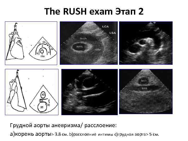 The RUSH exam Этап 2 Грудной аорты аневризма/ расслоение: a)корень аорты> 3. 8 см.