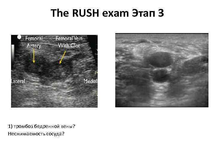 The RUSH exam Этап 3 1) тромбоз бедренной вены? Несжимаемость сосуда? 