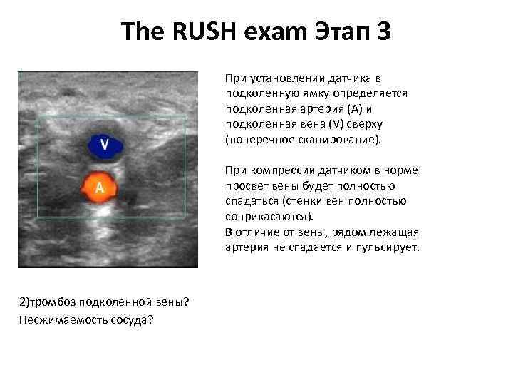 The RUSH exam Этап 3 При установлении датчика в подколенную ямку определяется подколенная артерия
